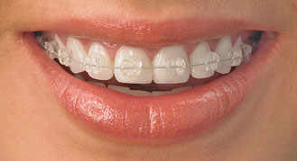 Ceramic Braces ceramic-braces