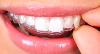 Clear Aligner clear-aligner